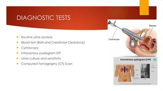 DIAGNOSTIC TESTS
 Routine urine analysis
 Blood test (BUN and Creatinine Clearance)
 Cystoscopy
 Intravenous pyelogram IVP
 Urine culture and sensitivity
 Computed Tomography (CT) Scan
 