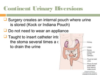 Continent Urinary Diversions 
 Surgery creates an internal pouch where urine 
is stored (Kock or Indiana Pouch) 
 Do not need to wear an appliance 
 Taught to insert catheter into 
the stoma several times a day 
to drain the urine 
 