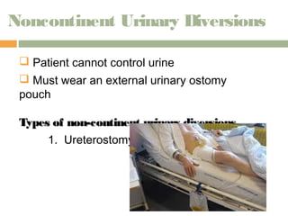 Noncontinent Urinary Diversions 
 Patient cannot control urine 
 Must wear an external urinary ostomy 
pouch 
Types of non-continent uurriinnaarryy ddiivveerrssiioonnss 
1. Ureterostomy 
 