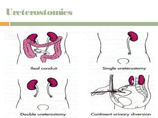 Ureterostomies 
