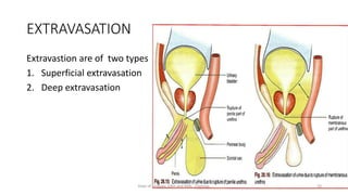 EXTRAVASATION
Extravastion are of two types
1. Superficial extravasation
2. Deep extravasation
10
Dept of Urology, GRH and KMC, Chennai.
 