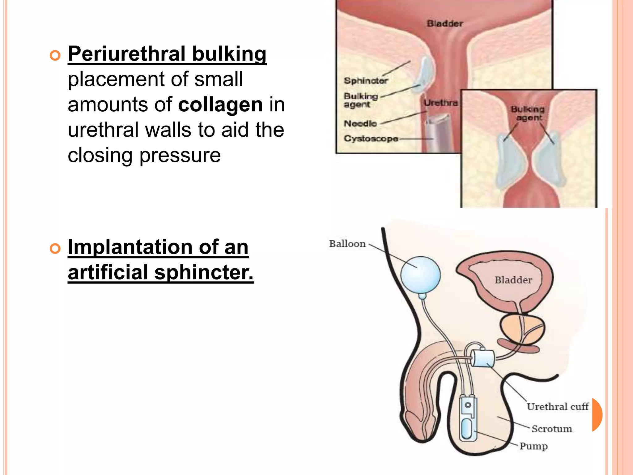 Positional Incontinance Urinary incontinance & retention of urine , nursing care | PPTX