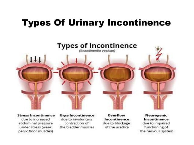 Urinary incontinence - Causes, types, management | PPTX