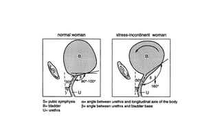 URINARY INCONTINENCE, stress urinary incontinence | PPTX