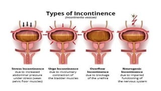 URINARY INCONTINENCE, stress urinary incontinence | PPTX