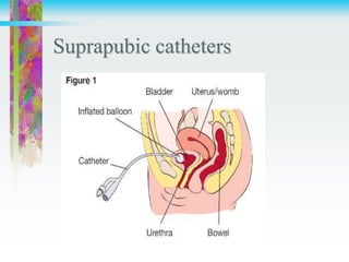 Suprapubic catheters
 