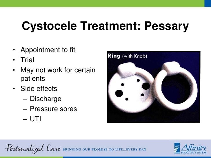 Cystocele Treatment Natural Cystocele Treatment Natural