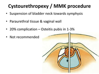 Urinary incontinence in females operative | PPTX