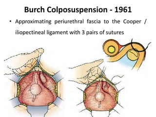 Burch Colposuspension