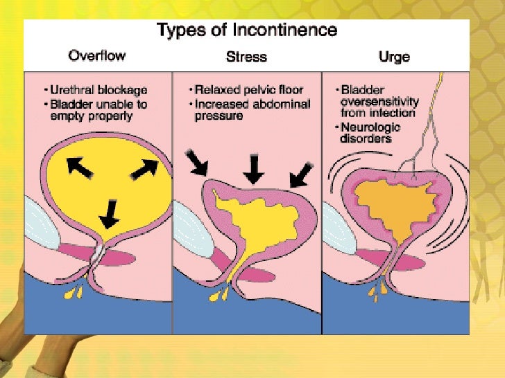 Urinary Incontinence
