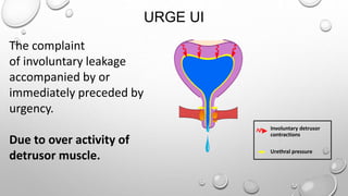 URGE UI
Involuntary detrusor
contractions
Urethral pressure
The complaint
of involuntary leakage
accompanied by or
immediately preceded by
urgency.
Due to over activity of
detrusor muscle.
 