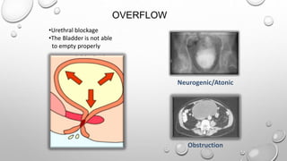 OVERFLOW
Neurogenic/Atonic
Obstruction
•Urethral blockage
•The Bladder is not able
to empty properly
 