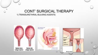 CONT’ SURGICAL THERAPY
1) TRANSURETHRAL BULKING AGENTS:
 