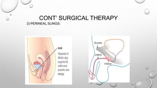 CONT’ SURGICAL THERAPY
2) PERINEAL SLINGS:
 