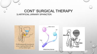 CONT’ SURGICAL THERAPY
3) ARTIFICIAL URINARY SPHINCTER:
 