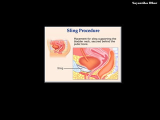 Surgical Management of Urinary Incontinence | PPT