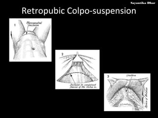 Sayantika Dhar


Retropubic Colpo-suspension
 