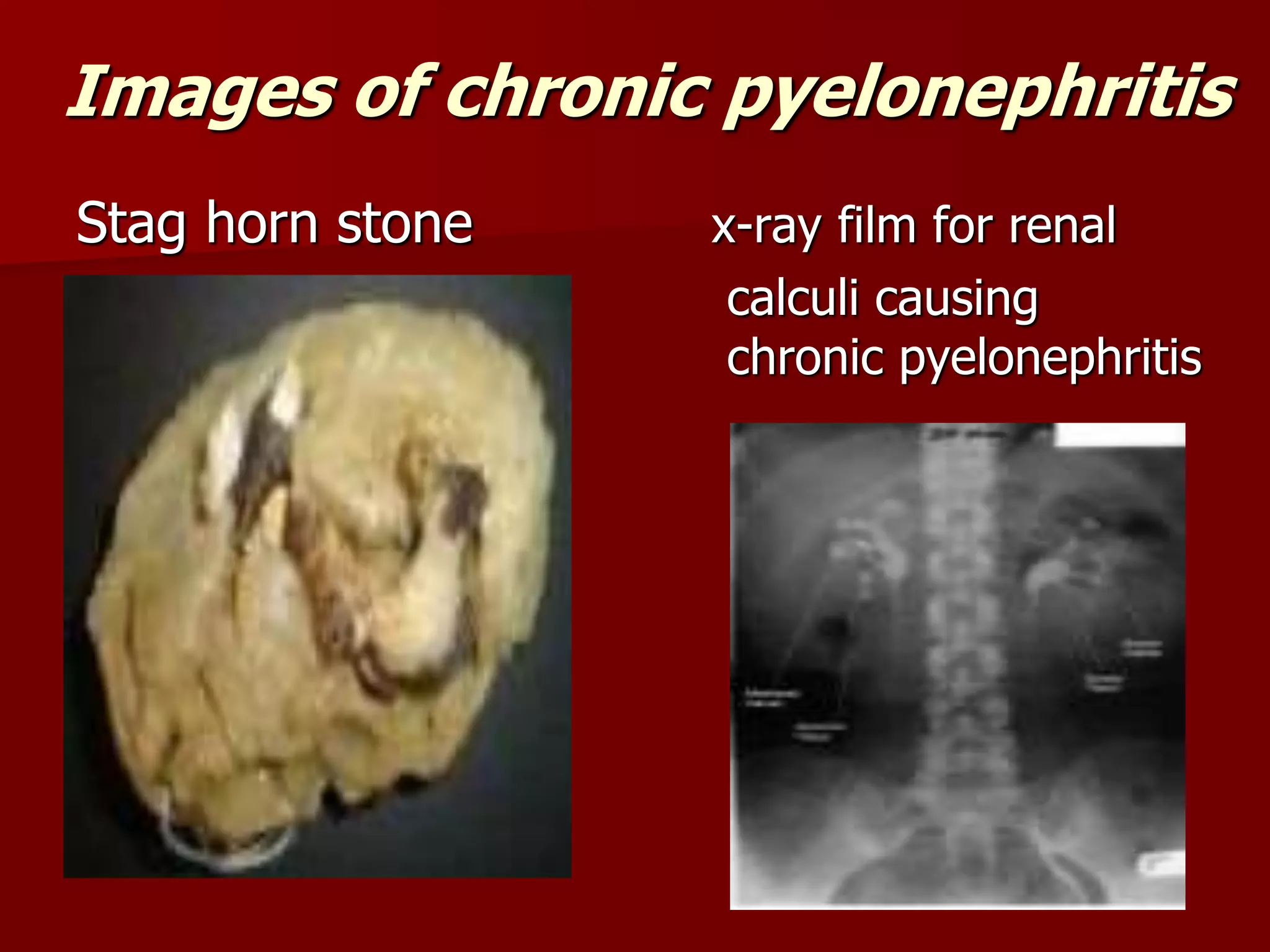 Images of chronic pyelonephritis
Stag horn stone x-ray film for renal
calculi causing
chronic pyelonephritis
 