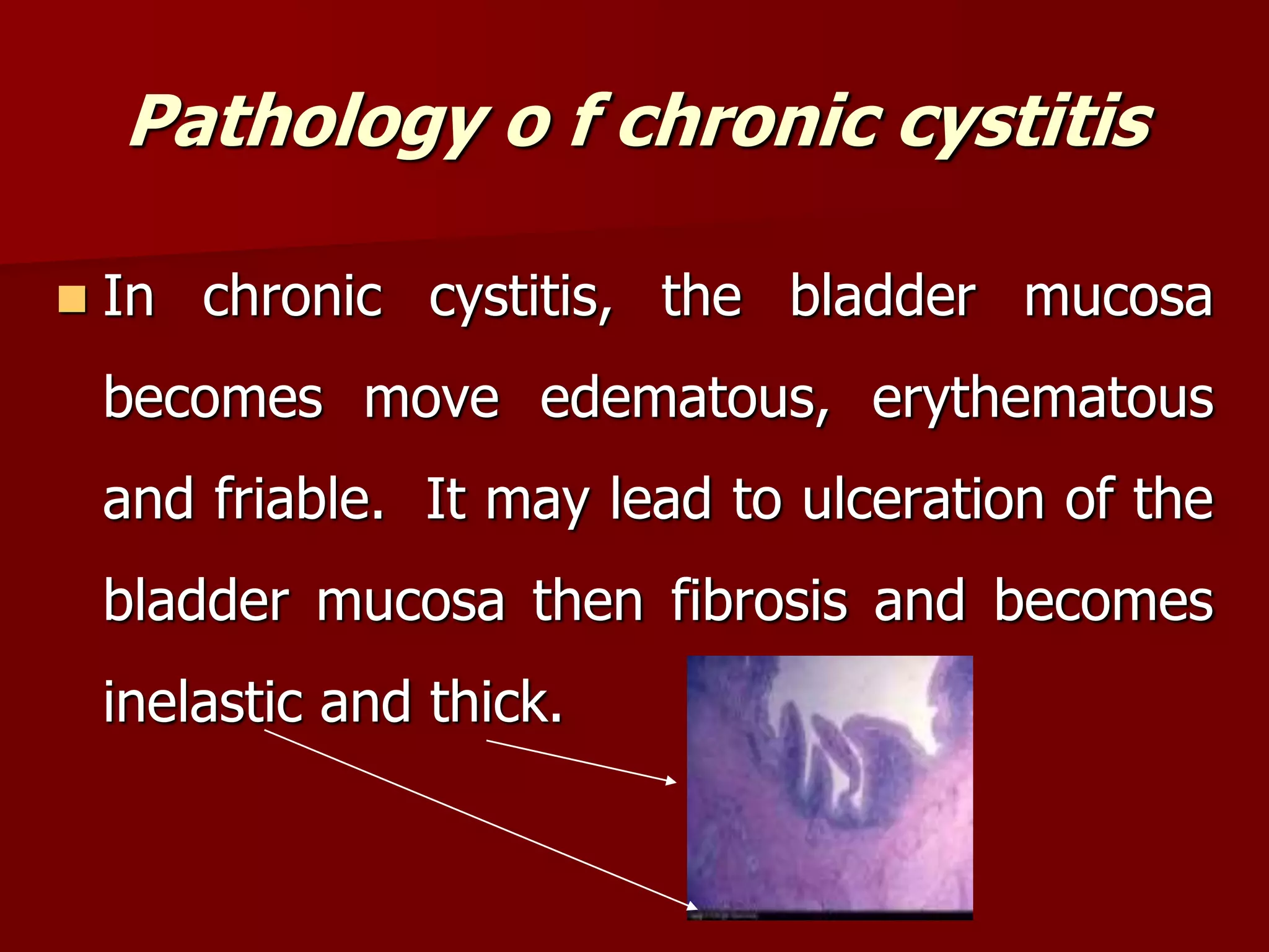 Pathology o f chronic cystitis
 In chronic cystitis, the bladder mucosa
becomes move edematous, erythematous
and friable. It may lead to ulceration of the
bladder mucosa then fibrosis and becomes
inelastic and thick.
 
