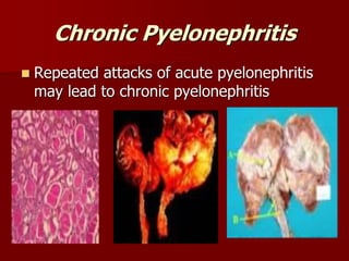 Chronic Pyelonephritis
 Repeated attacks of acute pyelonephritis
may lead to chronic pyelonephritis
 