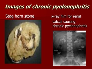Images of chronic pyelonephritis
Stag horn stone x-ray film for renal
calculi causing
chronic pyelonephritis
 