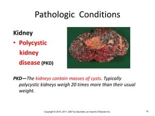Copyright © 2014, 2011, 2007 by Saunders, an imprint of Elsevier Inc. 15
Pathologic Conditions
Kidney
• Polycystic
kidney
disease (PKD)
PKD—The kidneys contain masses of cysts. Typically
polycystic kidneys weigh 20 times more than their usual
weight.
 