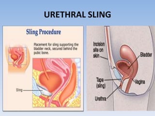 URETHRAL SLING
 
