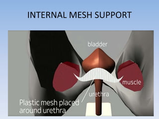 INTERNAL MESH SUPPORT
 
