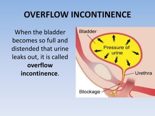 OVERFLOW INCONTINENCE
When the bladder
becomes so full and
distended that urine
leaks out, it is called
overflow
incontinence.
 