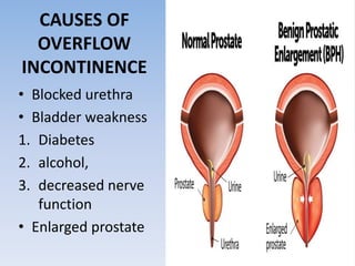 CAUSES OF
OVERFLOW
INCONTINENCE
• Blocked urethra
• Bladder weakness
1. Diabetes
2. alcohol,
3. decreased nerve
function
• Enlarged prostate
 
