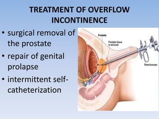 TREATMENT OF OVERFLOW
INCONTINENCE
• surgical removal of
the prostate
• repair of genital
prolapse
• intermittent self-
catheterization
 