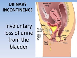 URINARY
INCONTINENCE
involuntary
loss of urine
from the
bladder
 