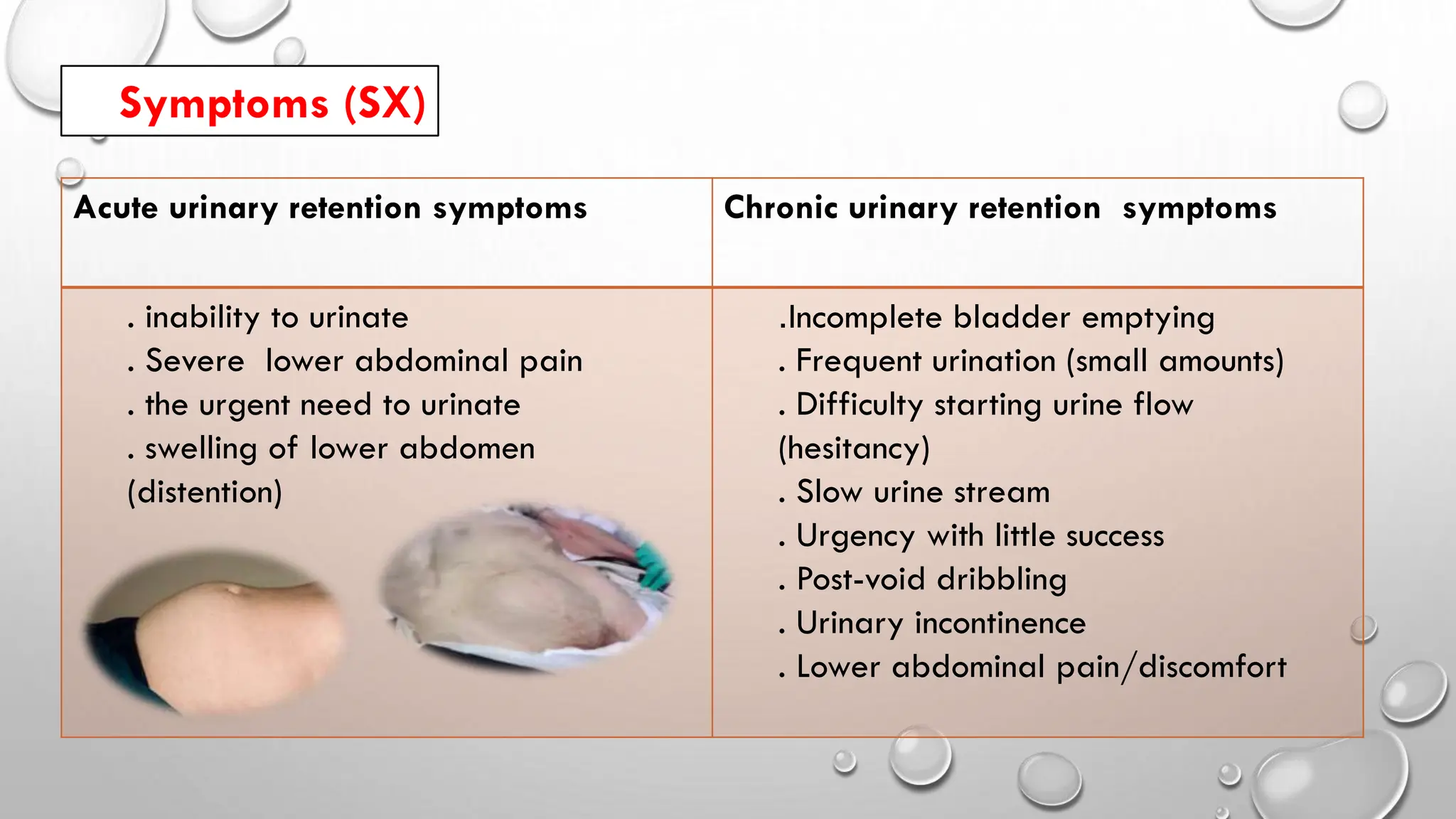 Urinary retention seminar........pdf. by Hamzah Al-haddad | PDF