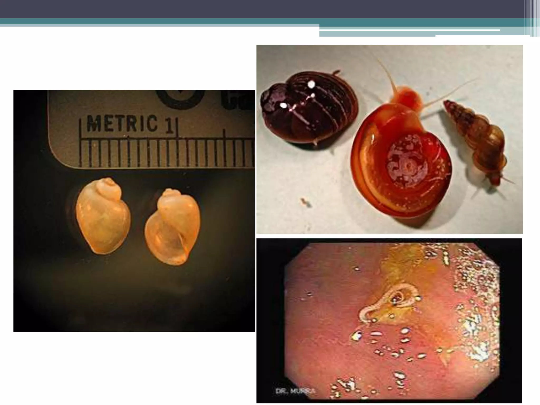 Insect Bladder Urinary schistosomiasis | PPTX