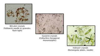 Bilirubin crystals
(Yellowish needle or granules;
flash light)
Cysteine crystals
(Colourless hexagonal;
monomorphic)
Indinavir crystals
(Rectangular plates, needle)
 