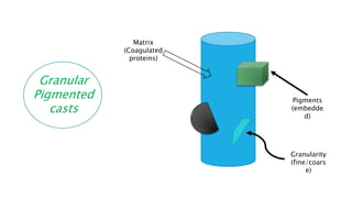 Granular
Pigmented
casts
Matrix
(Coagulated
proteins)
Pigments
(embedde
d)
Granularity
(fine/coars
e)
 