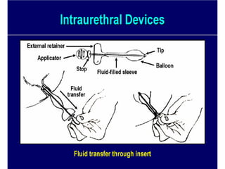 Urinary STRESS Incontinence Copy.pdf