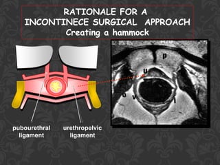 Urinary Stress Incontinence In Women | PDF
