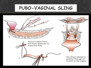 Urinary Stress Incontinence In Women | PDF