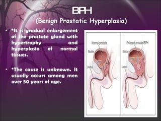 BPH (Benign Prostatic Hyperplasia) *It is gradual enlargement of the prostate gland with hypertrophy and hyperplasia of normal tissues. *The cause is unknown. It usually occurs among men over 50 years of age. 