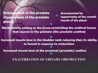 Enlargement of the prostate (hyperplasia of the prostate gland)  Accompanied by hypertrophy of the smooth muscle of the gland Mechanically adding to the tissue constricting the urethral lumen that courses to the prostate (the  prostatic urethra ) Increased muscle tone in the bladder neck reducing then its ability to funnel in response to micturition Increased muscle tone at the proximal (prostatic) urethra EXACERBATION OF URINARY OBSTRUCTION 