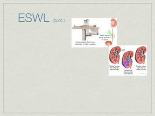 ESWL   (cont.)
 