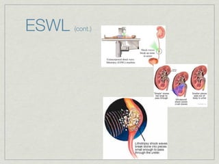 ESWL   (cont.)
 
