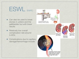 ESWL               (cont.)


Can also be used to break
stones in ureters and the
gallbladder but with lower
results

Relatively low overall
complication rate around
5-20%

Complications due to capillary
damage/hemorrhage include:
 