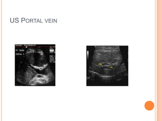 US PORTAL VEIN