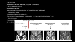 • Plain phase
Area scanned: kidneys or kidneys to bladder if haematuria
• Corticomedullary phase
Area scanned: kidney
Bolus tracking: 80HU at abdominal aorta at costophrenic angle level
• Nephrogenic phase
Area scanned: abdomen and pelvis
Approximately 60 seconds after IV contrast or 15 seconds after cortiomedullary scan
• Excretory phase
Area scanned: kidneys or kidneys to bladder
10 min delay
 