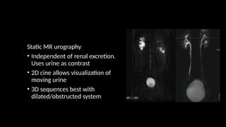 Static MR urography
• Independent of renal excretion.
Uses urine as contrast
• 2D cine allows visualization of
moving urine
• 3D sequences best with
dilated/obstructed system
 
