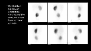 • Right pelvic
kidney, an
anatomical
variant and the
most common
form of renal
ectopia.
 