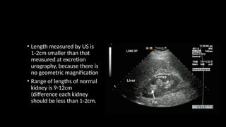 • Length measured by US is
1-2cm smaller than that
measured at excretion
urography, because there is
no geometric magnification
• Range of lengths of normal
kidney is 9-12cm
(difference each kidney
should be less than 1-2cm.
 