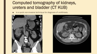Computed tomography of kidneys,
ureters and bladder (CT KUB)
■ is a quick non-invasive technique for diagnosis of urolithiasis.
 
